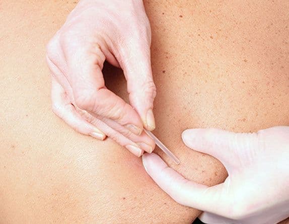 Dry needling for TMJ treatment